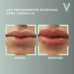 Aumento de labios - Clínica Doctora Villafañe