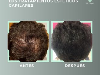 Tratamiento capilar antes y después - 878843