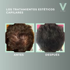 Tratamiento capilar - Clínica Doctora Villafañe
