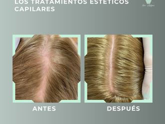 Tratamiento capilar antes y después - 878844