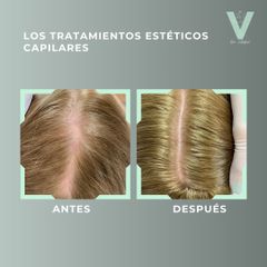 Tratamiento capilar - Clínica Doctora Villafañe