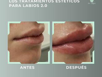 Aumento labios antes y después - 878845