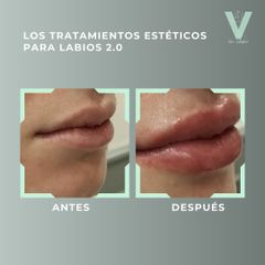 Aumento de labios - Clínica Doctora Villafañe