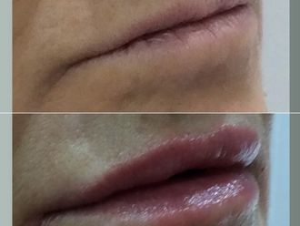 Aumento labios antes y después - 878846