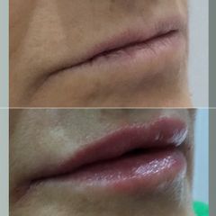 Aumento de labios - Clínica Doctora Villafañe