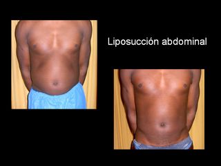 Liposucción