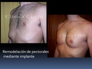 Implante de pectorales