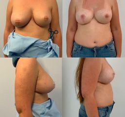 Mastopexia - Belaneve Clinics