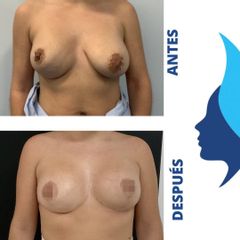 Mastopexia - Belaneve Clinics