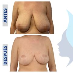 Reducción senos - Belaneve Clinics