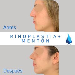 Rinoplastia - Belaneve Clinics