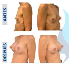 Aumento de pecho - Belaneve Clinics