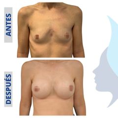 Aumento de pecho - Belaneve Clinics