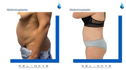 Abdominoplastia - Belaneve Clinics
