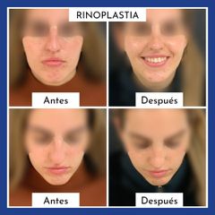 Rinoplastia - Belaneve Clinics
