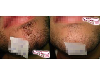 Antes y después Lesión dermatológica