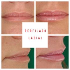 Aumento de labios - Clínica De Medicina Estética Córdoba