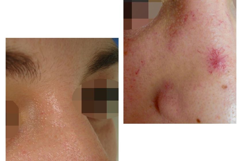 Láser vascular antes y después - 786780