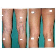 Tratamiento varices - Clínica De Medicina Estética Córdoba