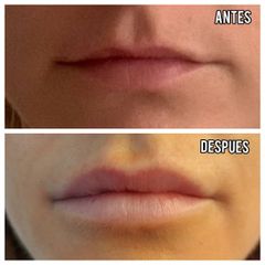 Aumento de labios - Centro Gimeno Alfós