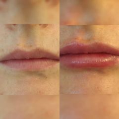 Aumento de labios - Centro Gimeno Alfós