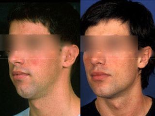 Antes y después Implantes faciales