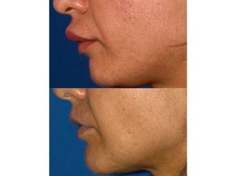 Queiloplastia - 501095