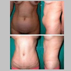 Antes y después Abdominoplastia