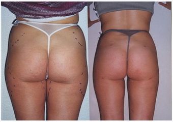 Antes y después Lipoescultura
