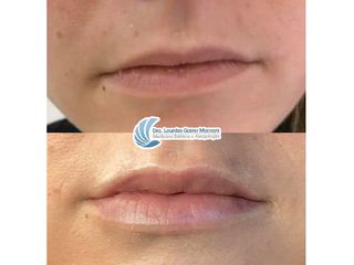 Antes y después Aumento de labios - Dra. Lourdes Gamo Macaya