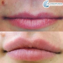 Aumento de labios - Dra. Lourdes Gamo Macaya