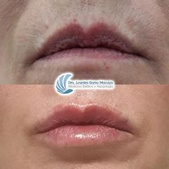 Aumento de labios - Dra. Lourdes Gamo Macaya
