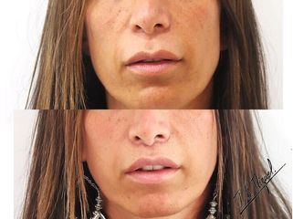 Antes y después Aumento de labios - Clínica Pedralbes