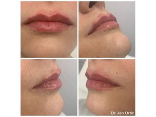 Aumento de labios - Clínica Pedralbes