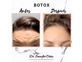 Clínica Pedralbes - Botox
