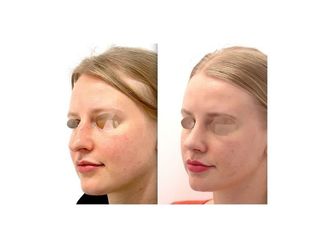 Rinoplastia - 794754