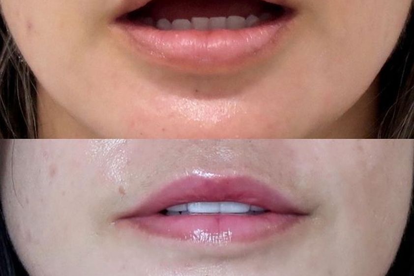 Queiloplastia antes y después - 801205