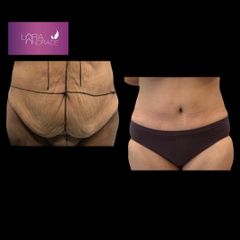 Abdominoplastia - Dr. Joffre Lara Andrade