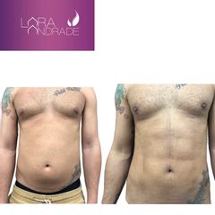 Liposucción - Dr. Joffre Lara Andrade