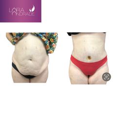 Abdominoplastia - Dr. Joffre Lara Andrade