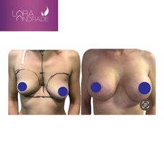 Mastopexia - Dr. Joffre Lara Andrade