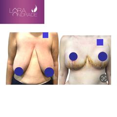Reducción senos - Dr. Joffre Lara Andrade