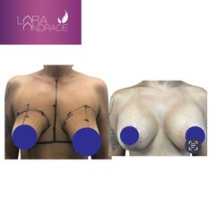 Mastopexia - Dr. Joffre Lara Andrade