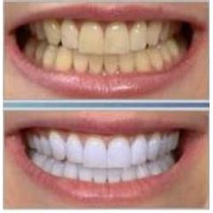 Antes y después blanqueamiento dental