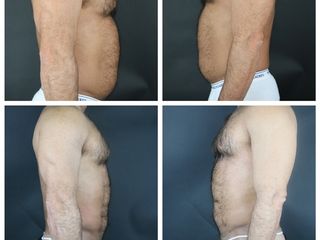 Liposucción - Dr. Ignacio Genol