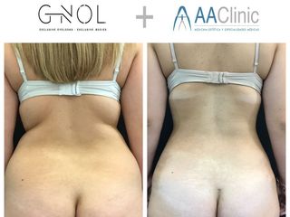 Vaser lipo - Dr. Ignacio Genol