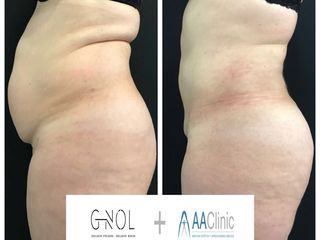 Vaser lipo - Dr. Ignacio Genol
