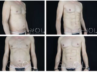 Vaser lipo - Dr. Ignacio Genol