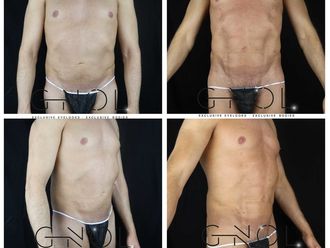 Marcación abdominal - 630624