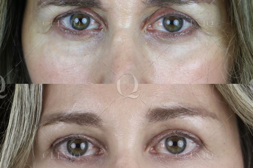 Blefaroplastia sin cirugía antes y después - 662881